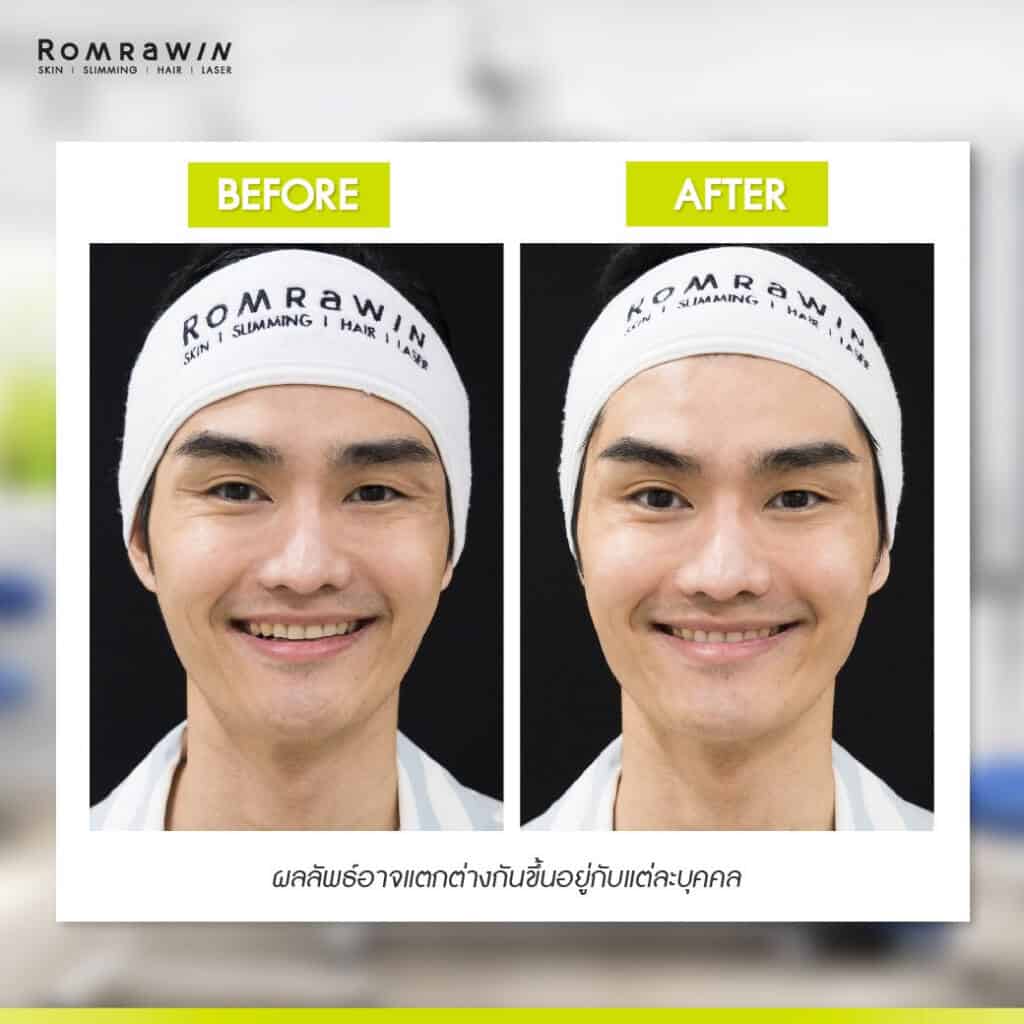โบท็อก รีวิว